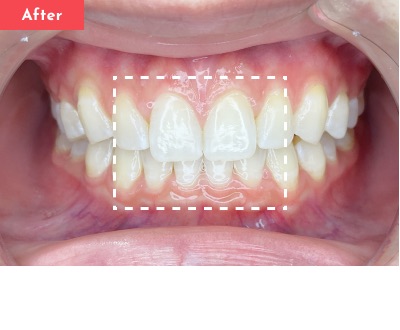 すきっ歯治療後 - Oh my teeth マウスピース矯正Basicプラン2ヶ月の症例 Case 27
